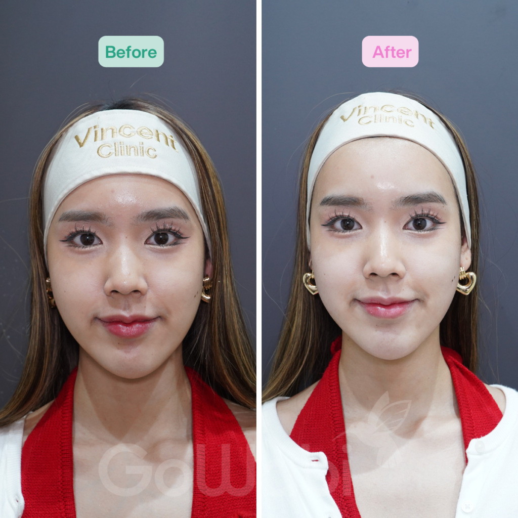 Vincent Clinic รีวิวผลลัพธ์หลังทำ UltraformerMPT