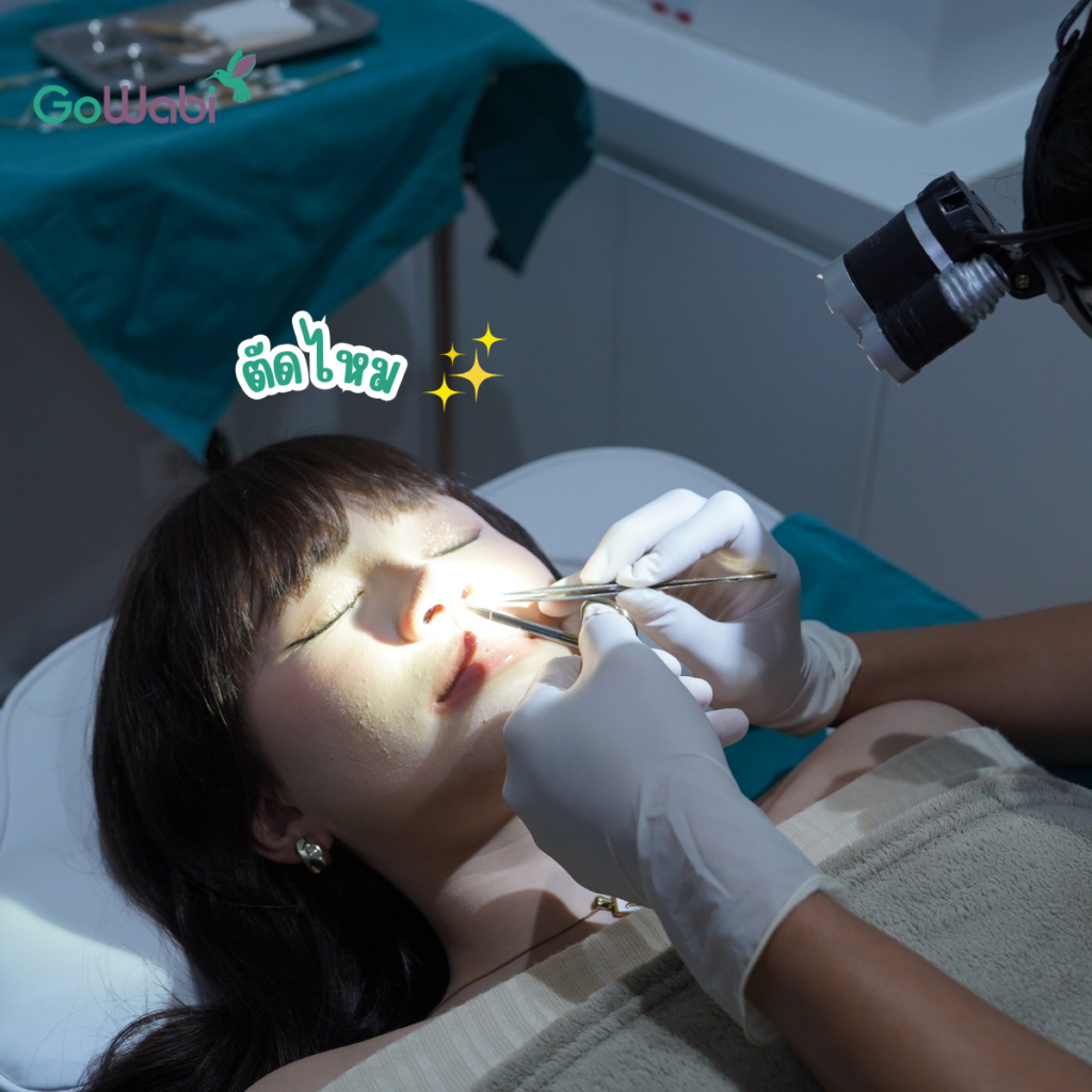 Vincent Clinic รีวิว หลังจากทำจมูก 14 วัน