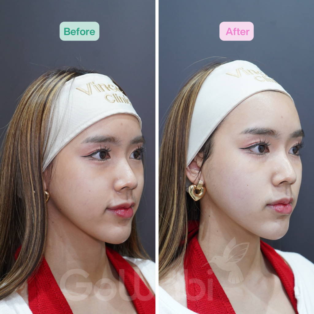Vincent Clinic รีวิวผลลัพธ์หลังทำ UltraformerMPT