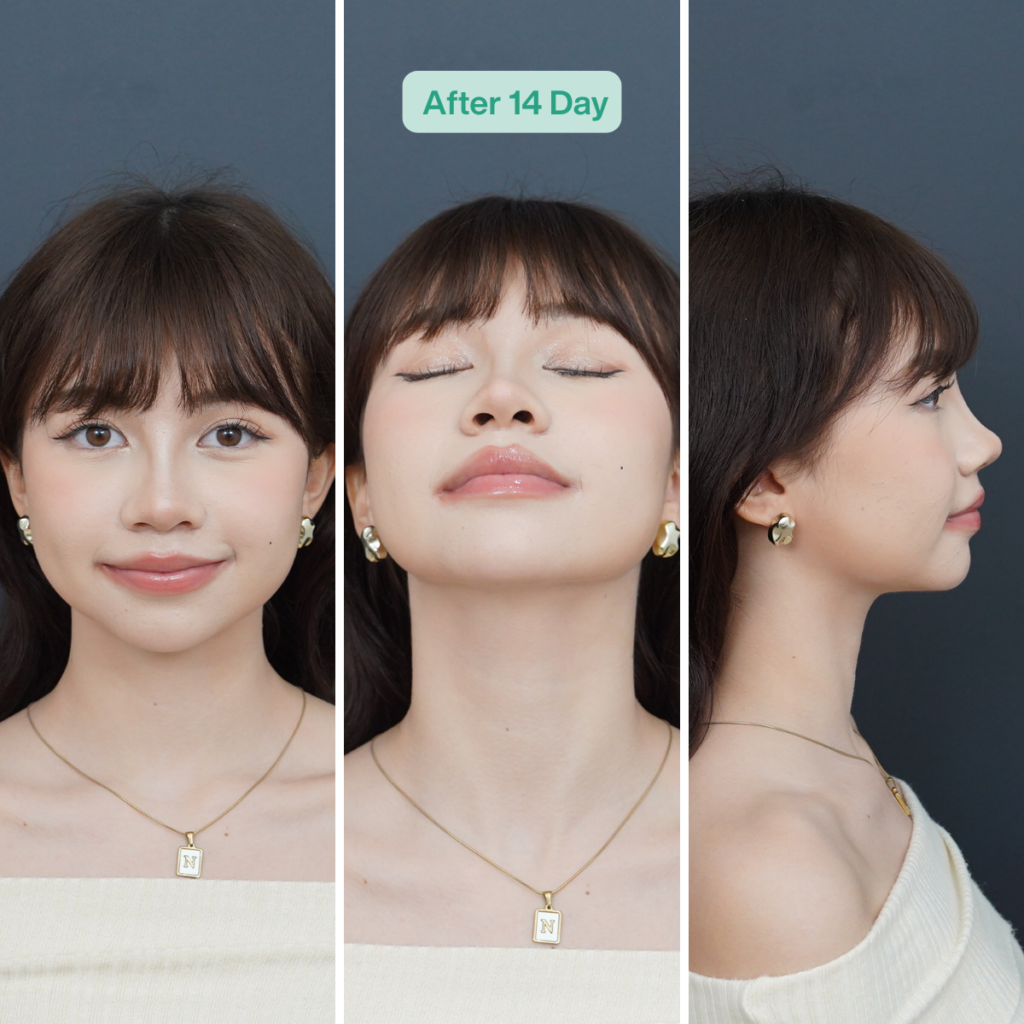วินเซนต์ คลินิก รีวิวเสริมจมูกหลังทำ 14 วัน