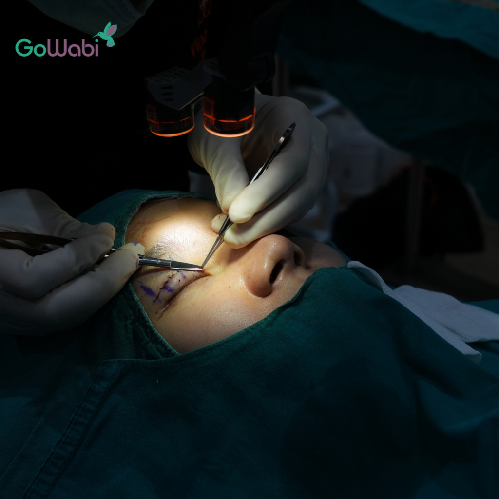 Vincent Clinic รีวิวทำตาสองชั้น