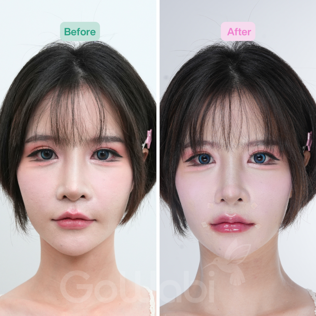 Vincent Clinic รีวิวฉีดฟิลเลอร์ปากก่อนและหลังทำ