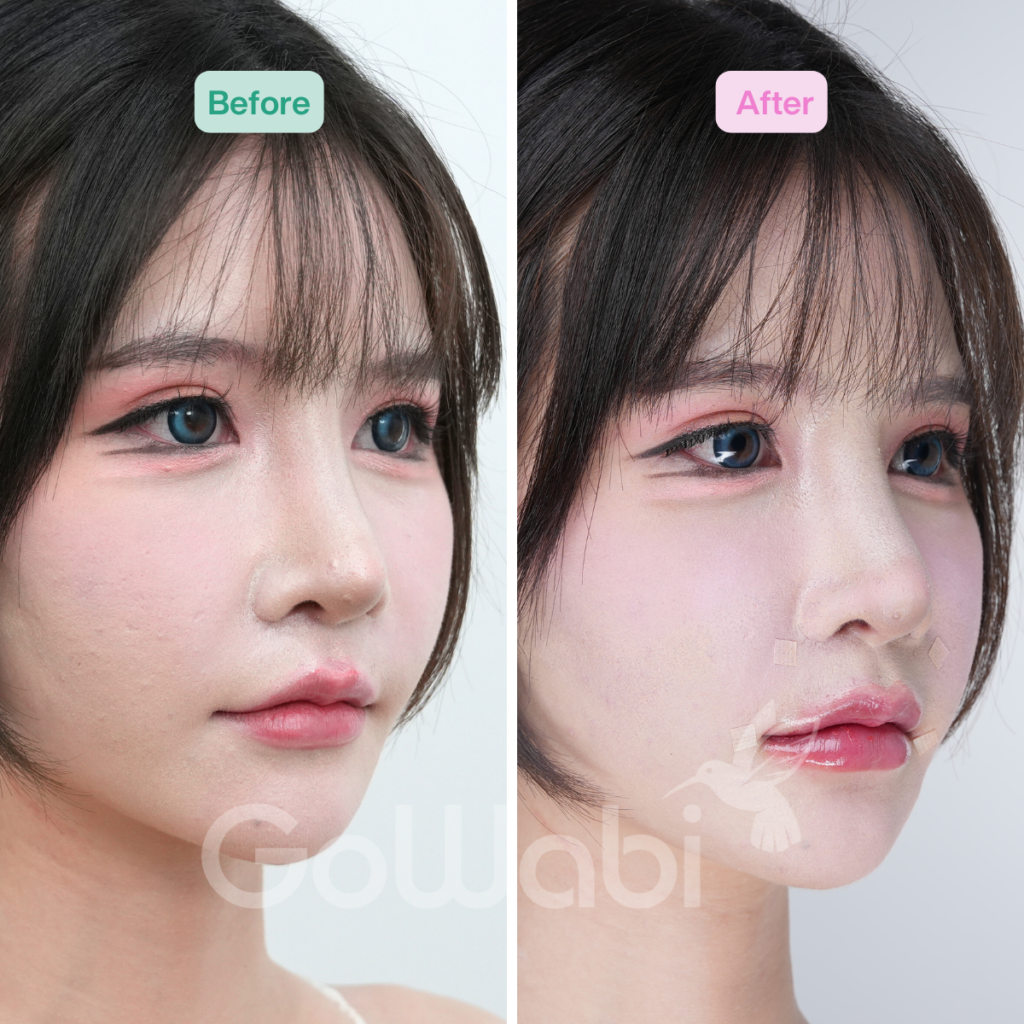 Vincent Clinic รีวิวฉีดฟิลเลอร์ปากก่อนและหลังทำมุมข้าง