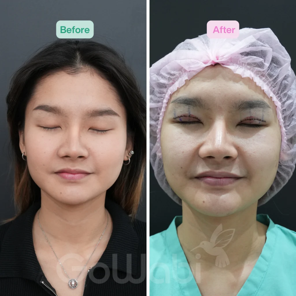Vincent Clinic รีวิวทำตาสองชั้นหลังทำทันที