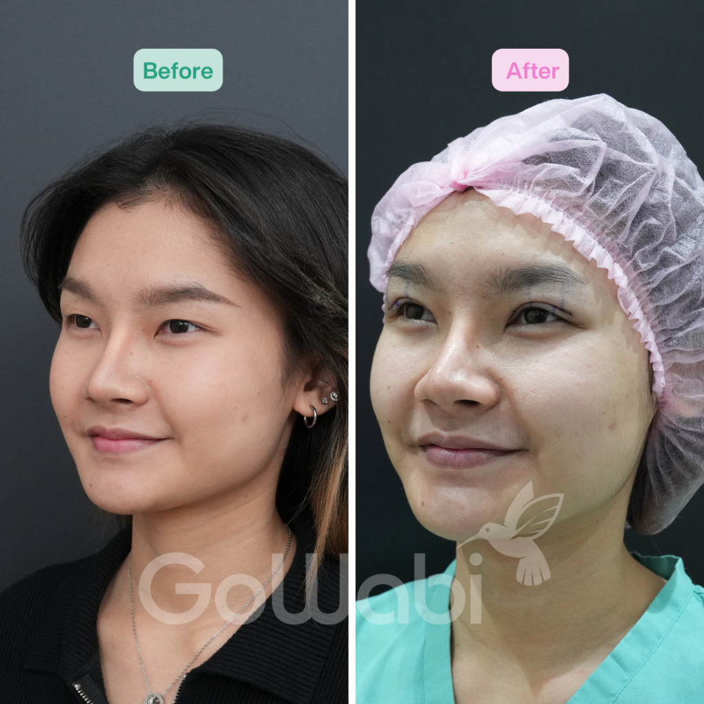 Vincent Clinic รีวิวทำตาสองชั้นหลังทำทันที