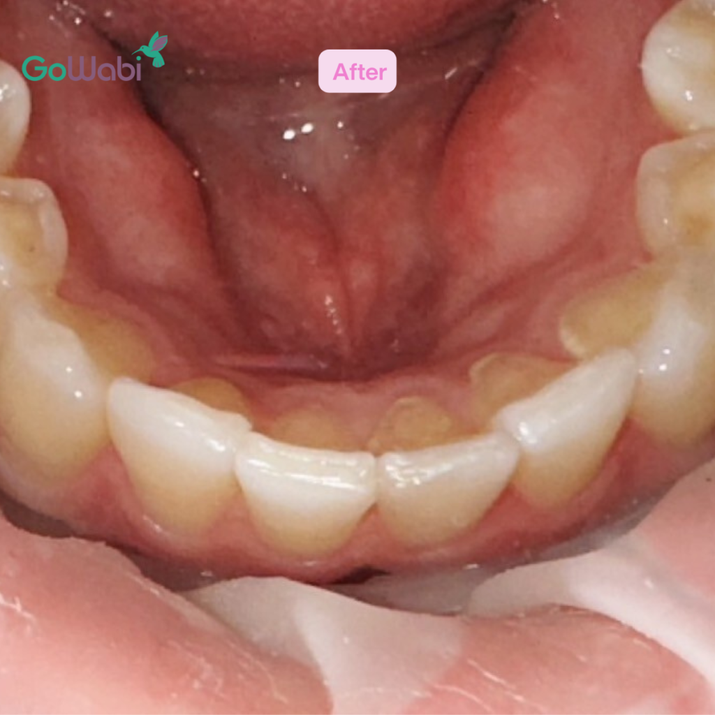 DCA Dental clinic รีวิวหลังจัดฟัน ภาพมุมล่าง