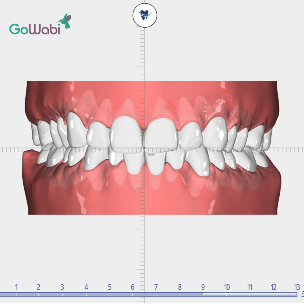 DCA Dental clinic รีวิวภาพจำลองก่อนการจัดฟันใส