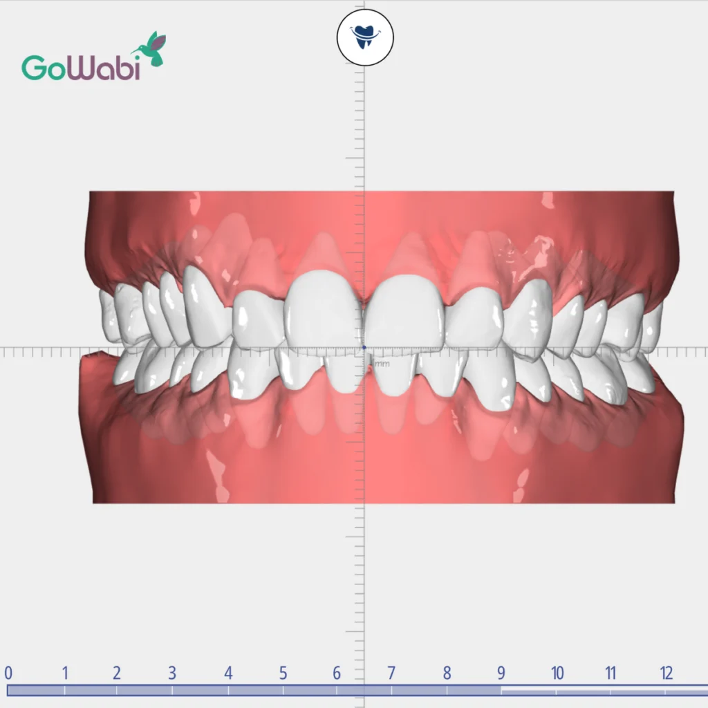 DCA Dental clinic รีวิวภาพจำลองสามมิติเมื่อจัดฟันใสเสร็จแล้ว
