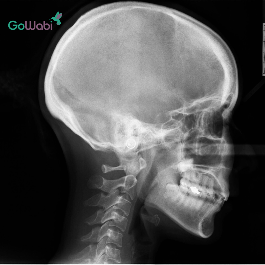 DCA Dental clinic รีวิวขั้นตอนการจัดฟันใสต้องเอ็กซเรย์ก่อน