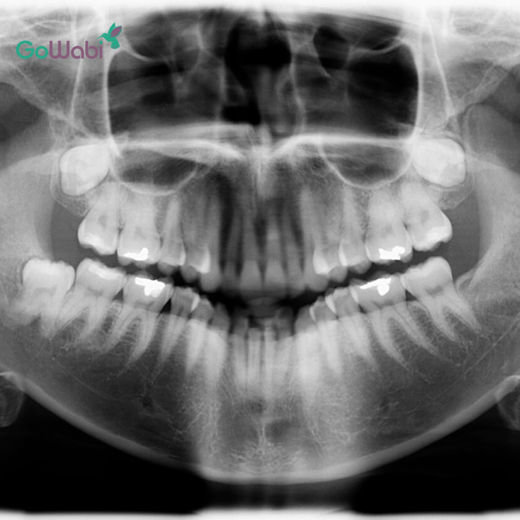 DCA Dental clinic รีวิวก่อนจัดฟันใส ตรวจฟันโดยการเอ็กซเรย์