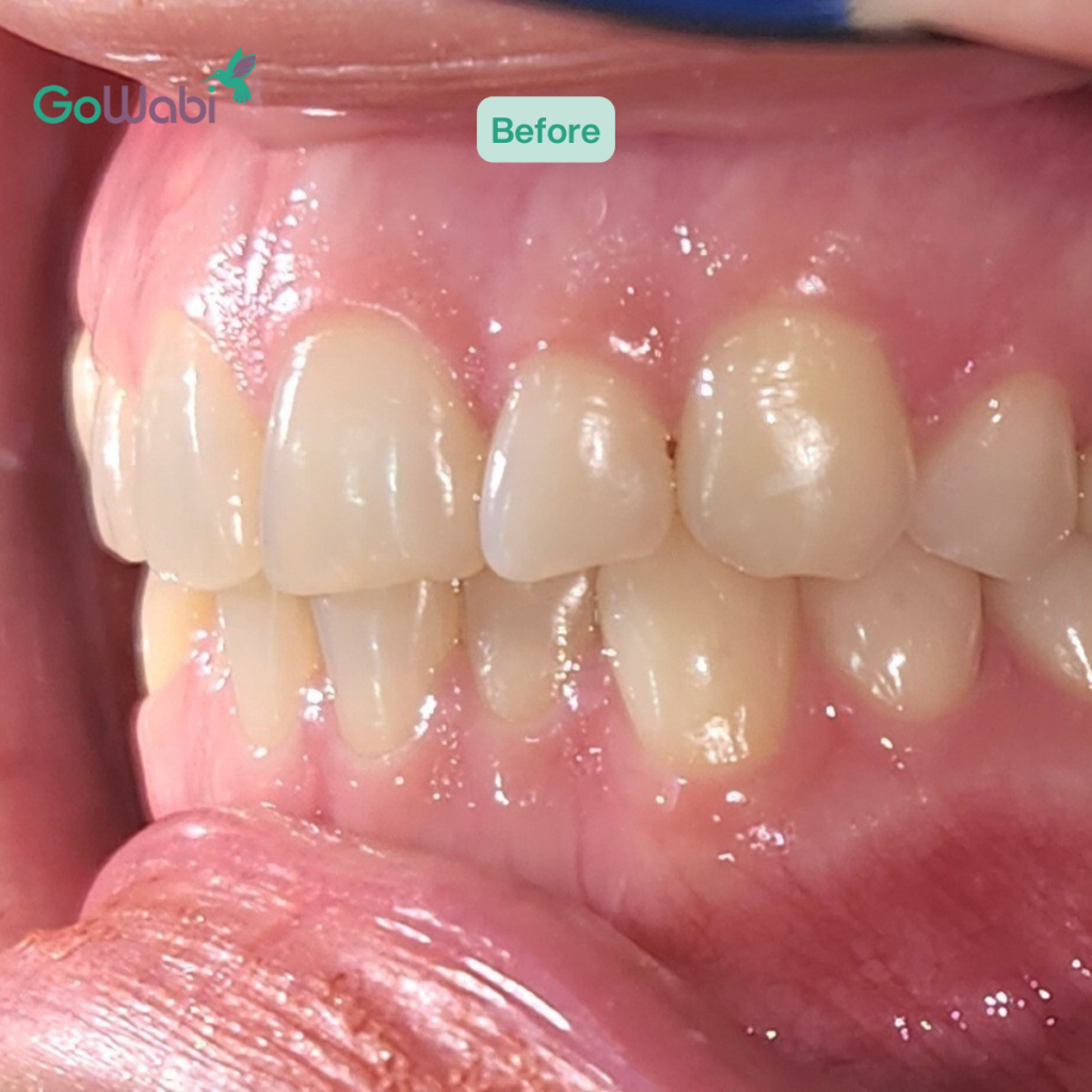 DCA Dental clinic รีวิวก่อนจักฟันใสภาพด้านข้าง