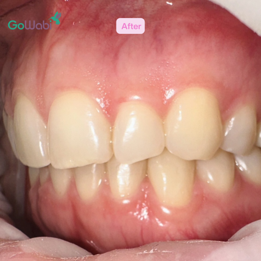 DCA Dental clinic รีวิวหลังจัดฟันใสภาพด้านข้าง