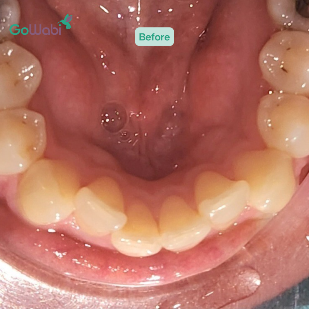 DCA Dental clinic รีวิวก่อนจัดฟัน ภาพมุมล่าง
