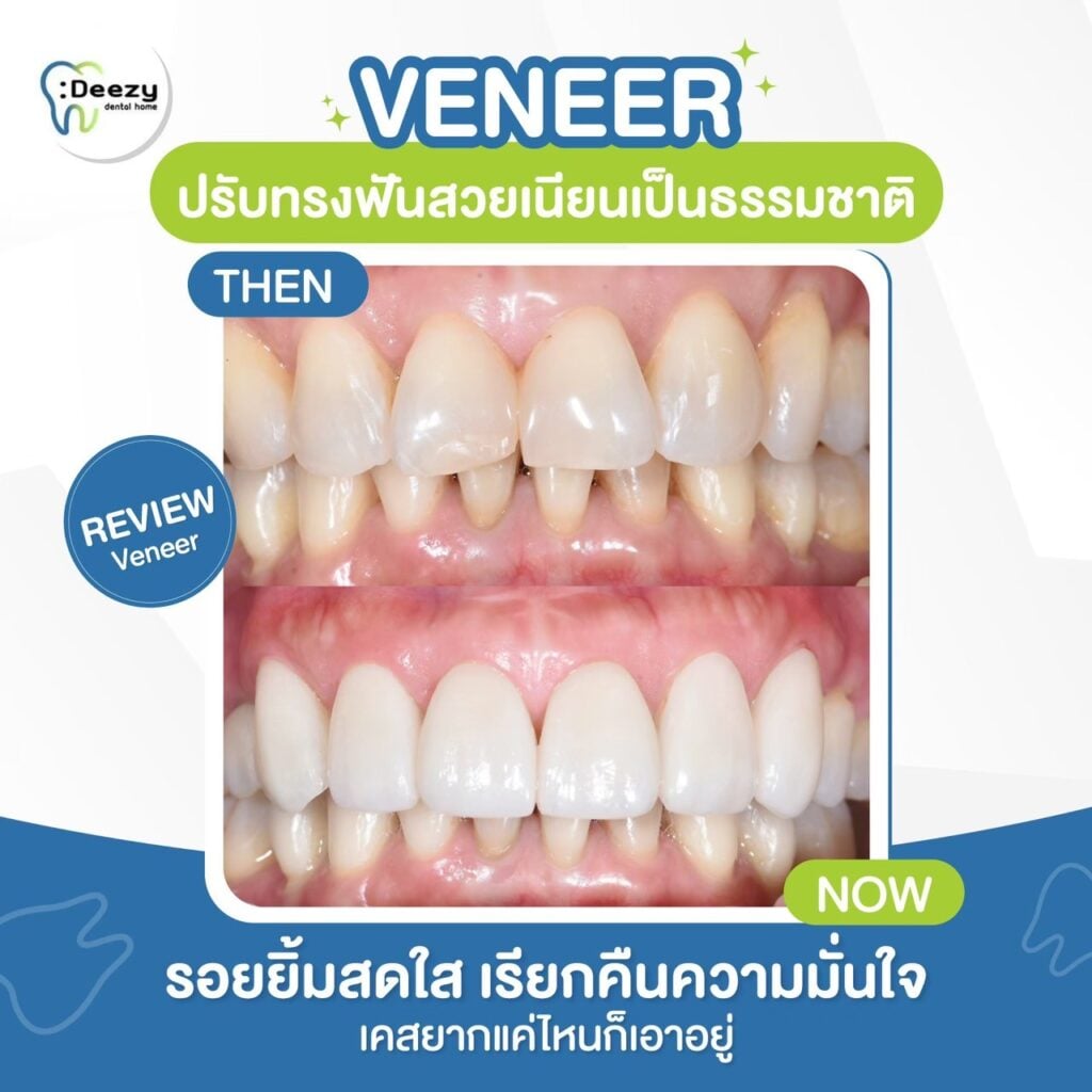 Deezy Dental Homeรีวิว รูปก่อนและหลังทำ