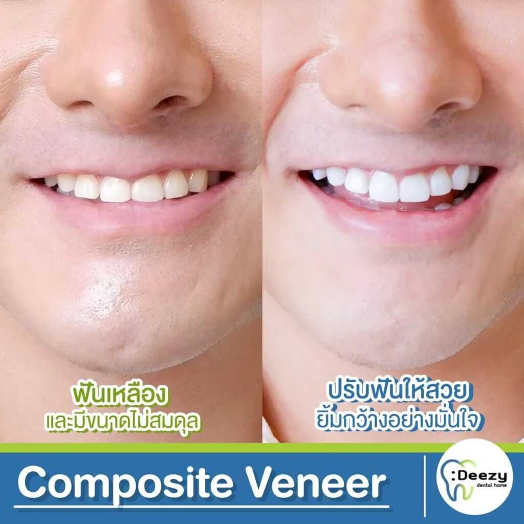 Deezy Dental Home รีวิว รูปทำฟัน