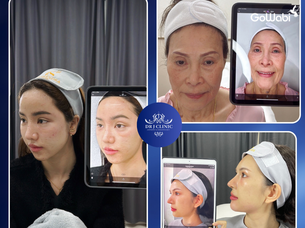 dr.j clinic รีวิวปรับรูปหน้าด้วย J-Lift™