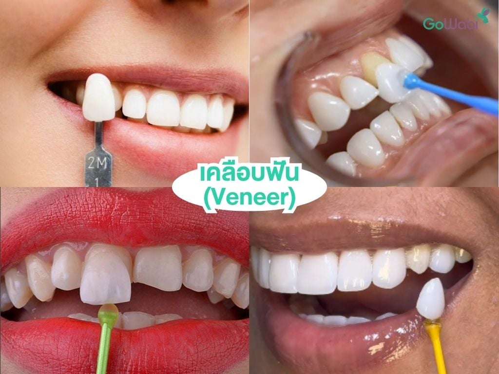 ฟันสวยแบบดาราด้วยการทำ veneer