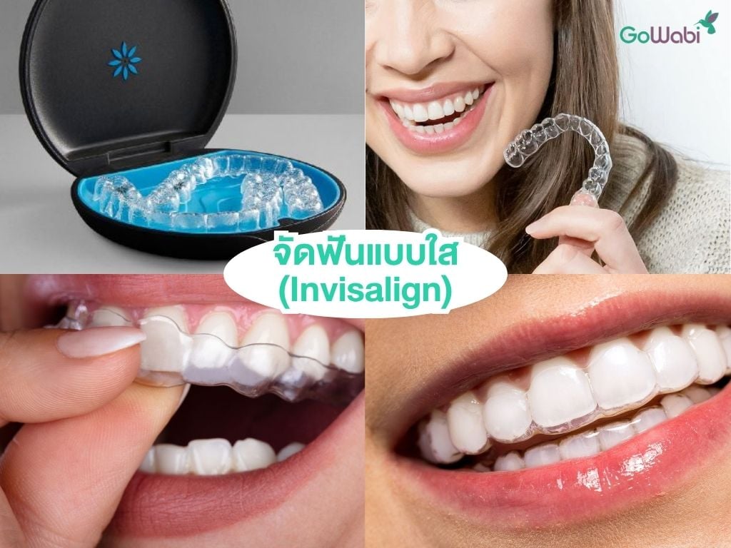 ฟันสวยแบบดาราด้วย invisalign