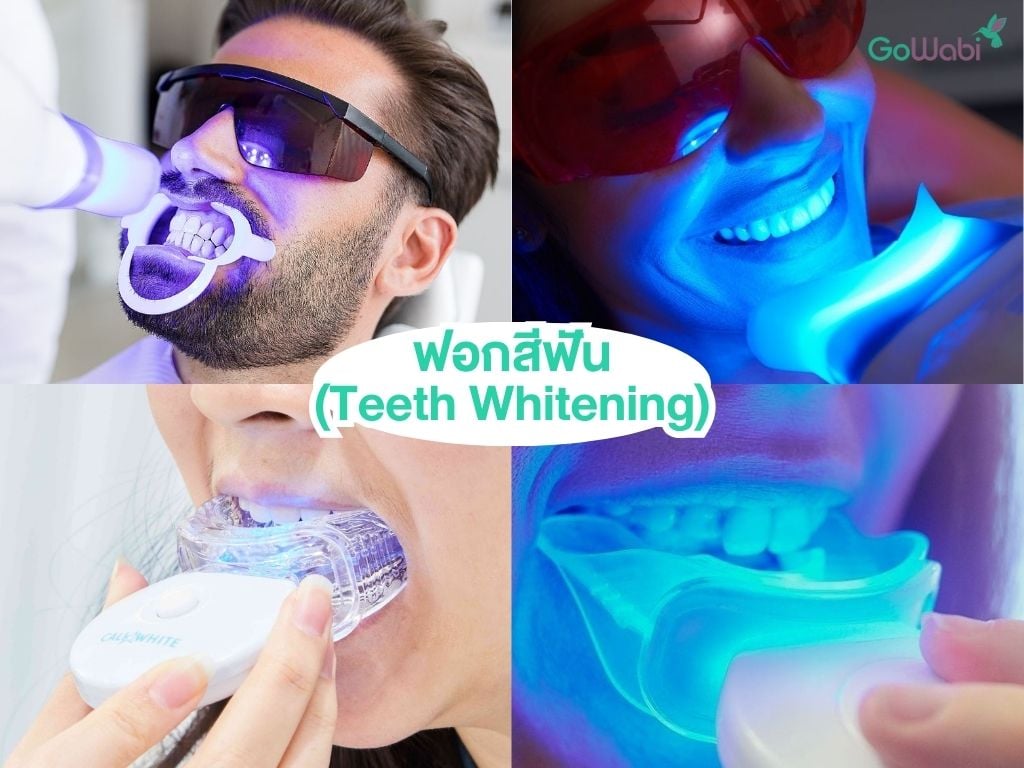 ฟันสวยแบบดาราด้วย การฟอกสีฟัน