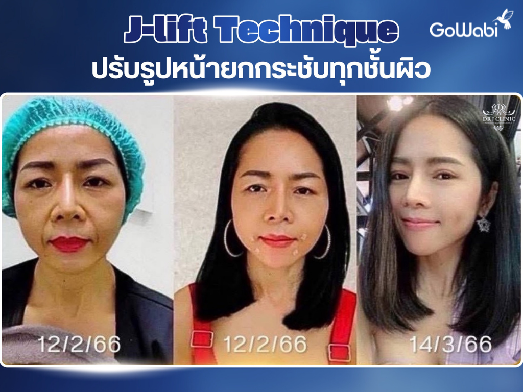 dr.j clinic ผลลัพธ์หลังทำ