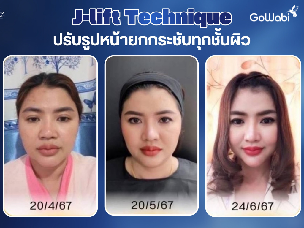 dr.j clinic ผลลัพธ์หลังทำ