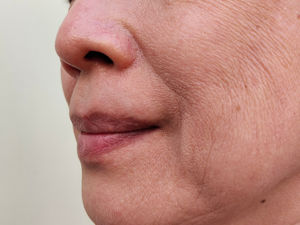 ผิวที่ขาด hyaluron