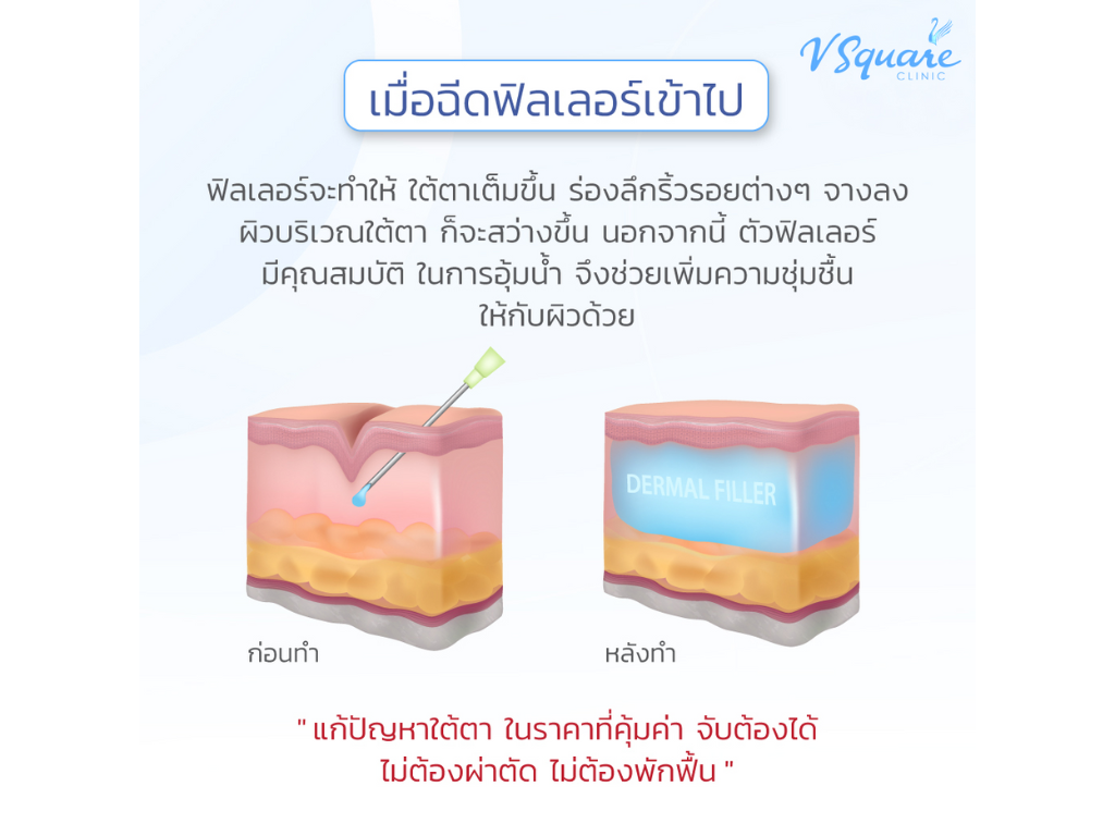 under-eye filler คืออะไร