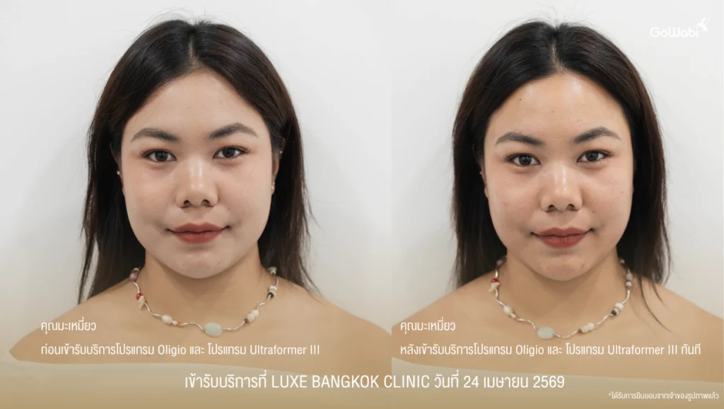 Luxe Bangkok Clinic รีวิว ภาพเปรียบเทียบหน้าตรง ก่อนและหลังเข้ารับบริการทันที