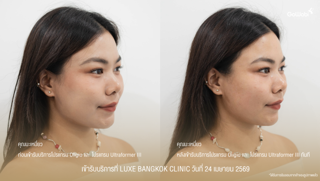 Luxe Bangkok Clinic รีวิว ภาพเปรียบเทียบมุมข้าง ก่อนและหลังเข้ารับบริการทันที